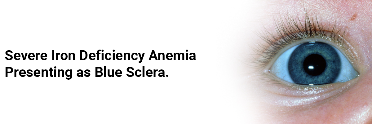 Severe Iron Deficiency Anemia Presenting As Blue Sclera